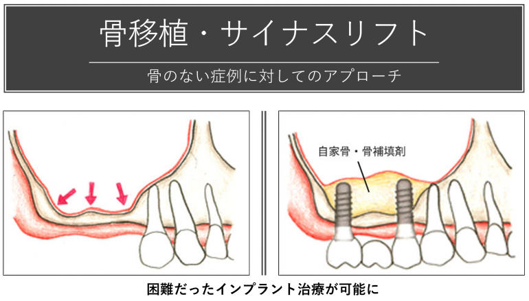 骨移植・サイナスリフト 骨のない症例に対してのアプローチ