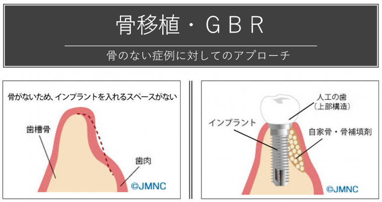 骨移植・GBR 骨のない症例に対してのアプローチ